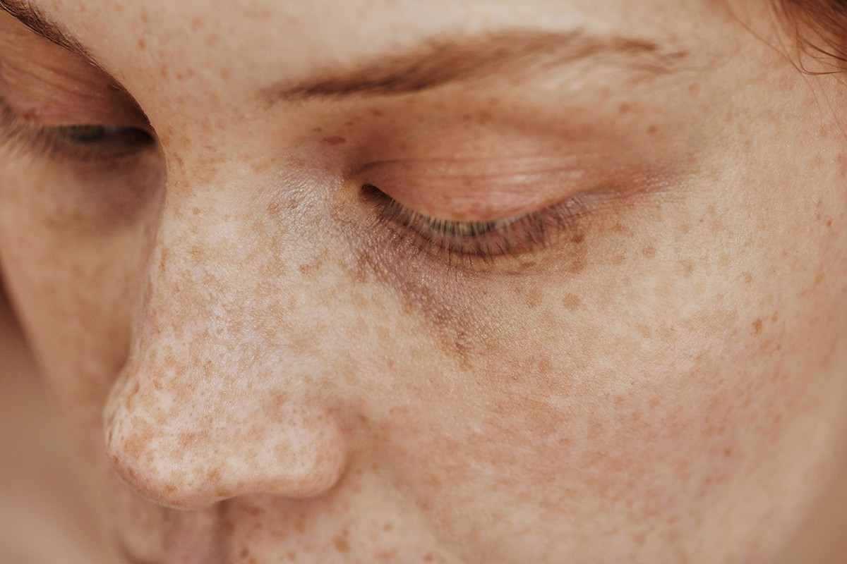 Ausschnitt des Gesichtes einer Frau mit vielen Sommersprossen