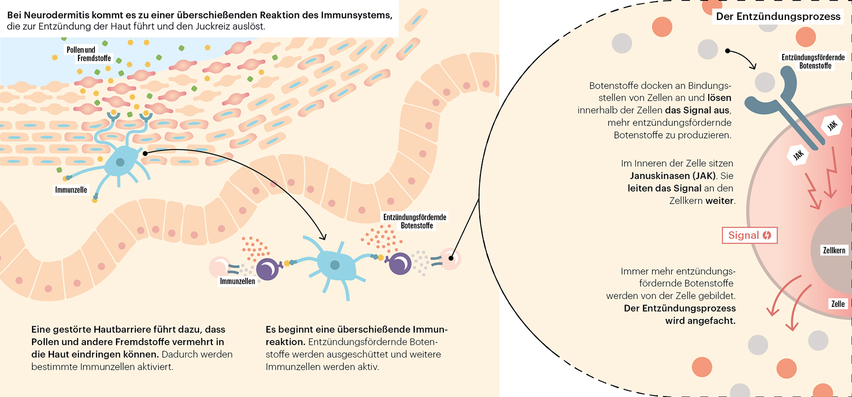Illustration Neurodermitis Illustration Neurodermitis