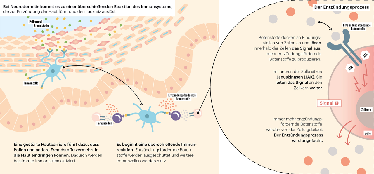 Illustration Neurodermitis