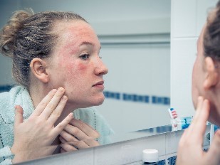Neurodermitis im Gesicht