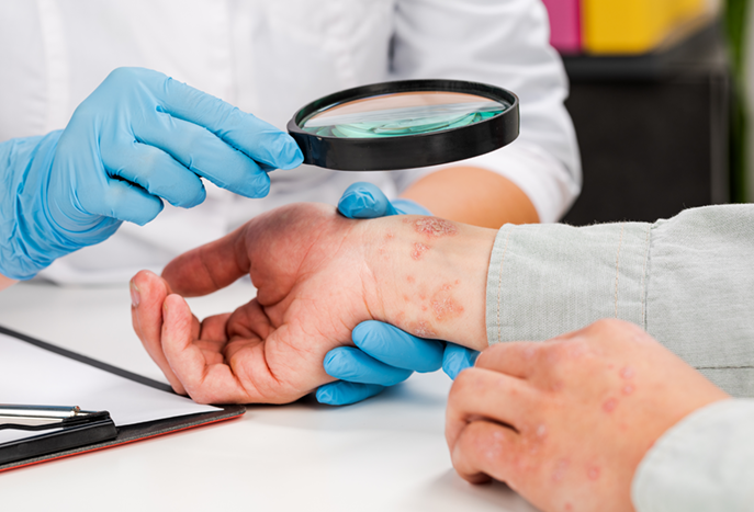 Neurodermitis-Diagnose beim Hautarzt